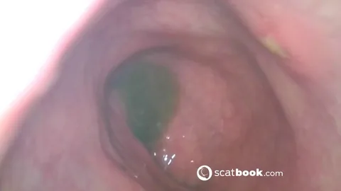 Sweet Tinqerbell - endoscope in my ass 2025-02-15 07 26